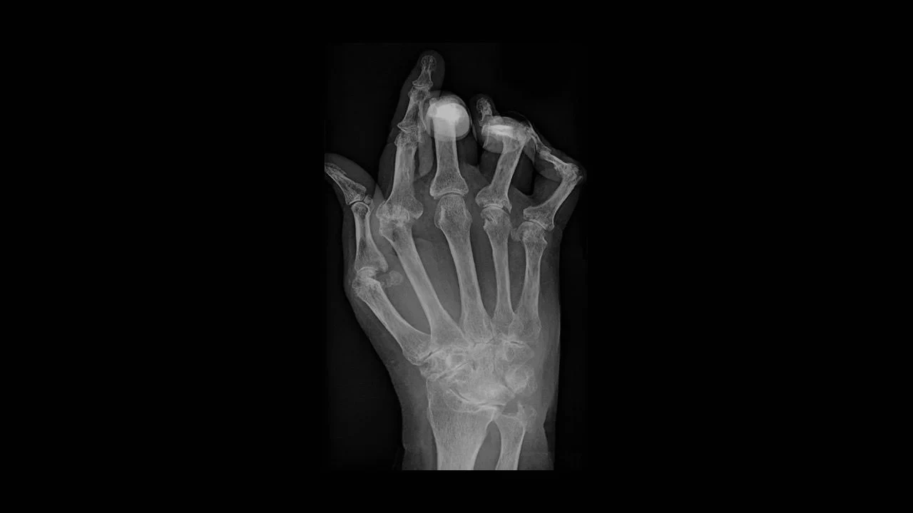 An X-ray of a hand with rheumatoid arthritis
